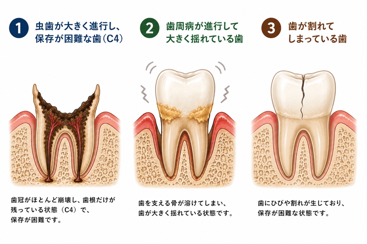 抜歯となる主な3つの理由の図解。1つ目は虫歯が大きく進行して歯冠がほとんど崩壊した歯（C4）、2つ目は歯周病で歯を支える骨が溶けて大きく揺れている歯、3つ目はひびや割れが生じた歯。